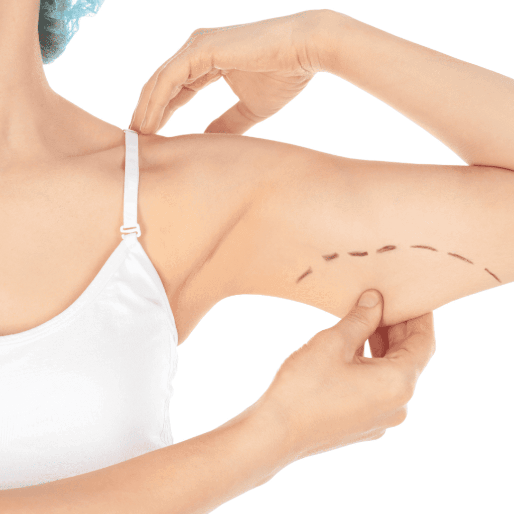 Arm Lift Surgery: What It Is and What to Expect