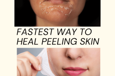 fastest way to heal peeling skin